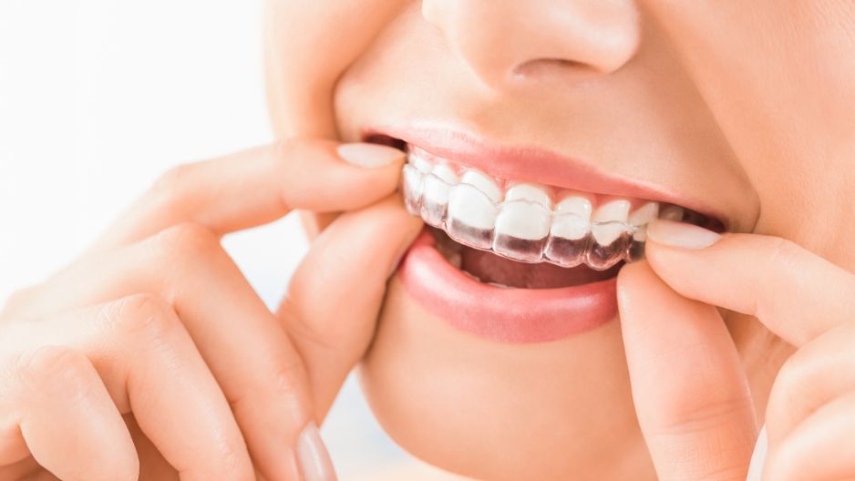 Aligner Therapy